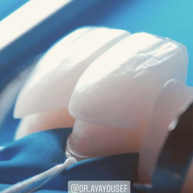 Dr. Aya Youssef the best Hollywood smile