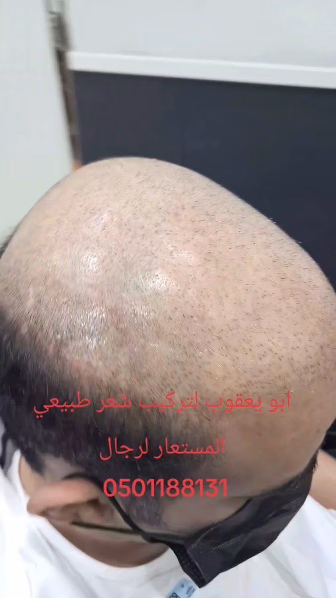حلاق تركي تلاقي تركيب شعر طبيعي المستعار