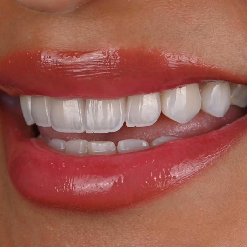 معمل زركون الماسي لتركيبات الاسنانDiamond Zercon Dental Lab