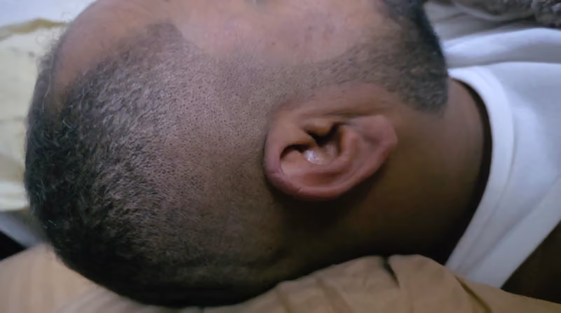 TR Hair Transplant Specialized Clinic | تي ار زراعة الشعر العيادات المتخصصة