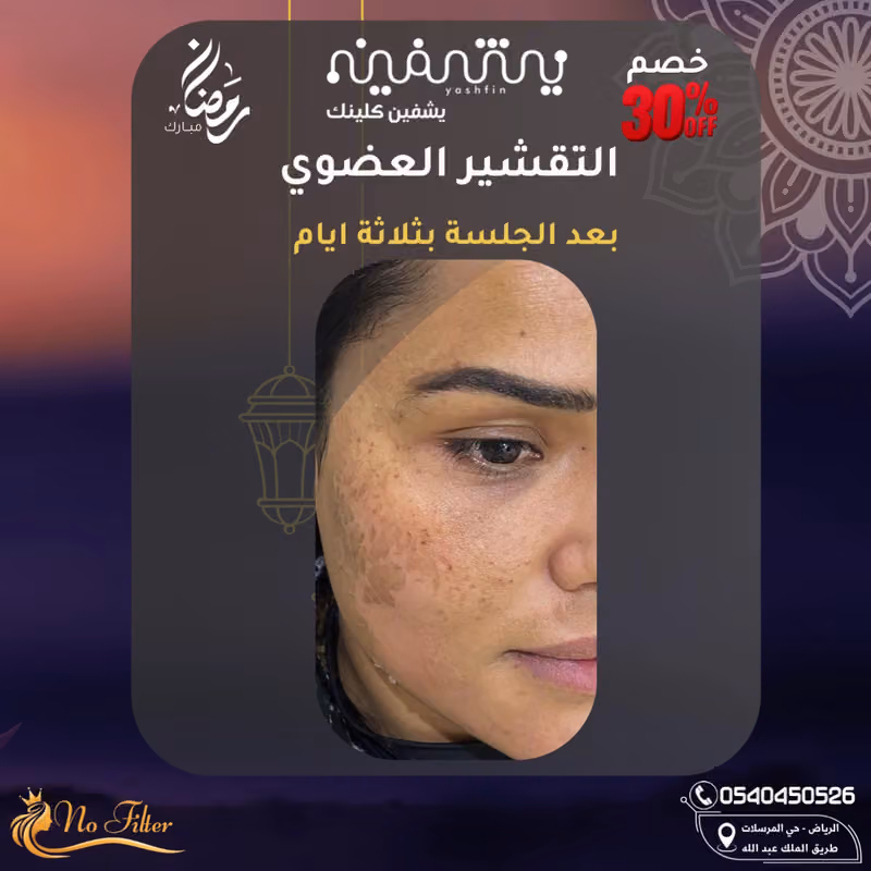 يشفين كلينك